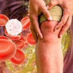 Cholesterol: Definition, Causes, symptoms and Treatment