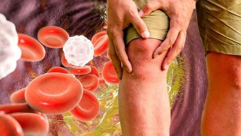 Cholesterol: Definition, Causes, symptoms and Treatment