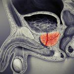 3D Treatment for Prostatitis Review