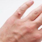 Get Rid of Warts On Hands