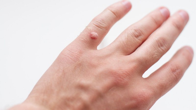 Get Rid of Warts On Hands