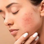 Ways to Get Rid of Pimples Naturally with the Right Treatment