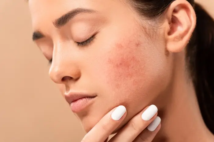 Ways to Get Rid of Pimples Naturally with the Right Treatment